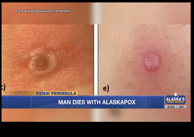 Elderly Man From Remote Wilderness Area Dies from Rare ‘Alaskapox’ Infection